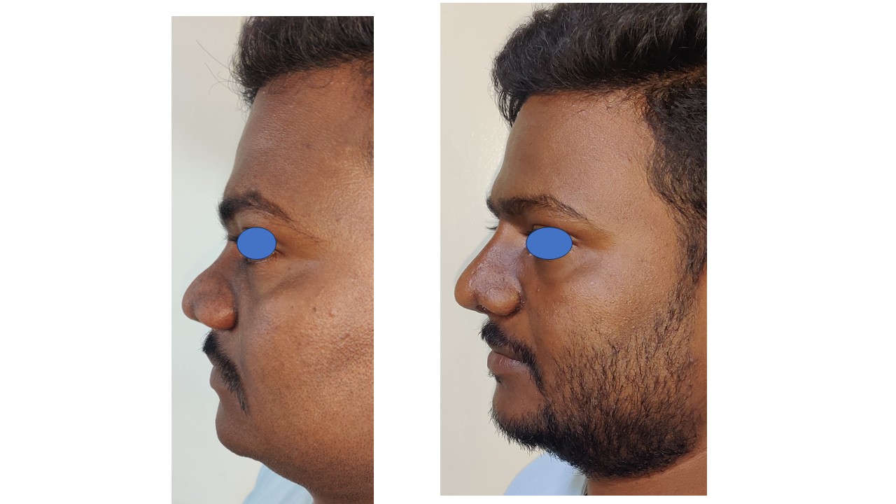 Rhinoplasty Photo 7